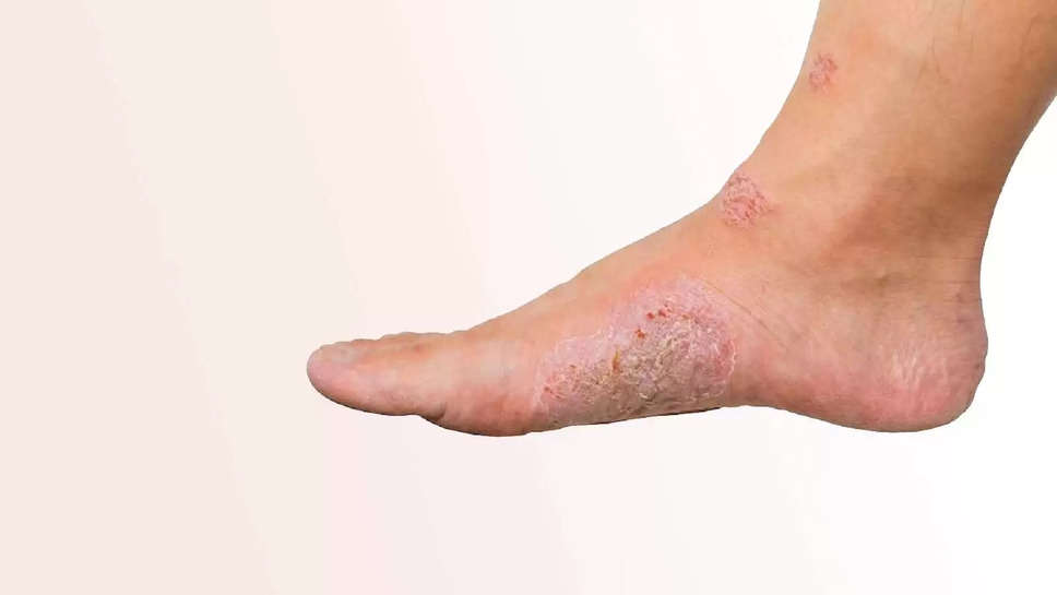 Diabetic Foot Ulcer: जानिए शुगर के मरीज को क्यों रहता है डायबिटिक फुट अल्सर का खतरा, ये हैं लक्षण कैसे करें बचाव