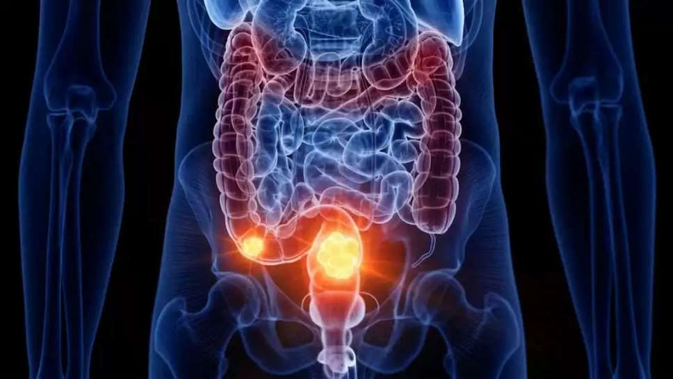 Bowel Cancer: जानिए क्या हैं हड्डियों तक कैंसर फैलने के लक्षण, बन सकता है जानलेवा 